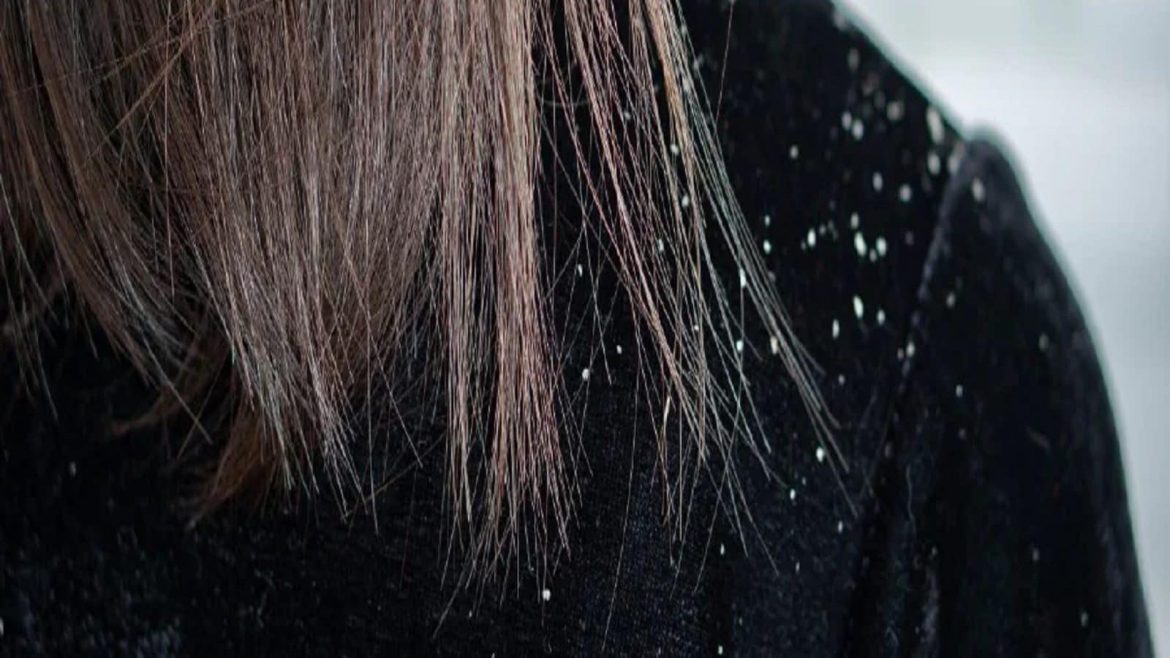 dandruff-166823189316×9.jpg